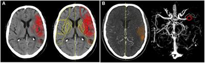 Artificial intelligence-based decision support software to improve the efficacy of acute stroke pathway in the NHS: an observational study